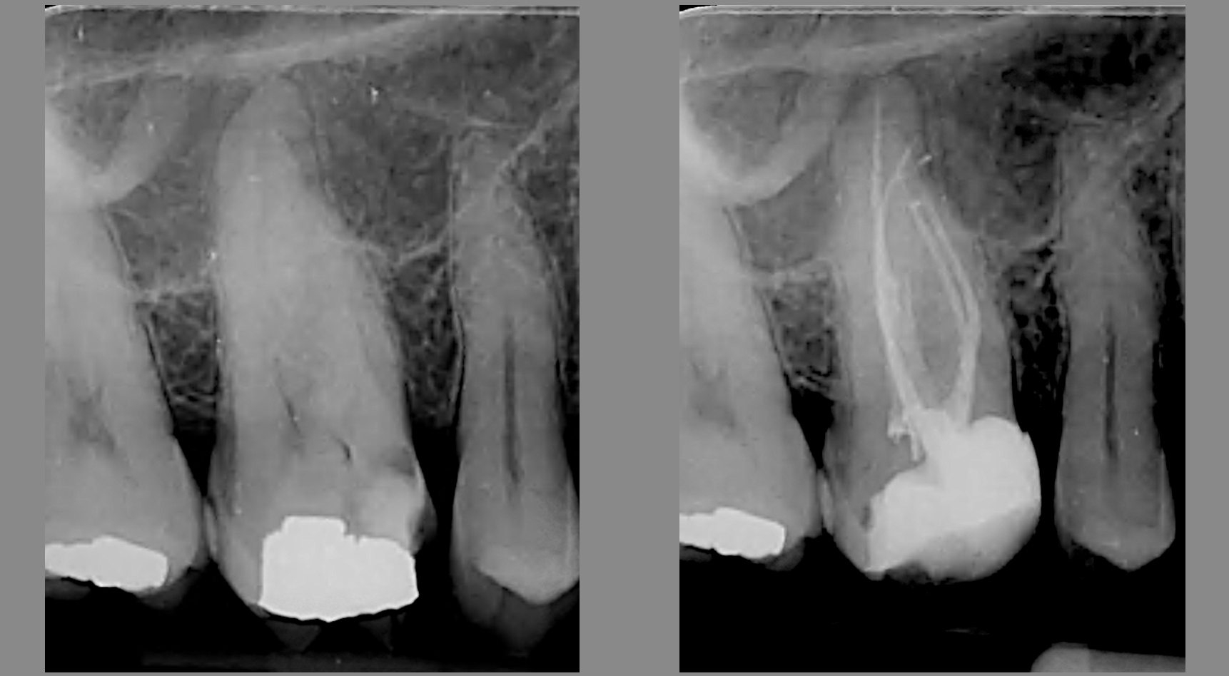 xray of teeth